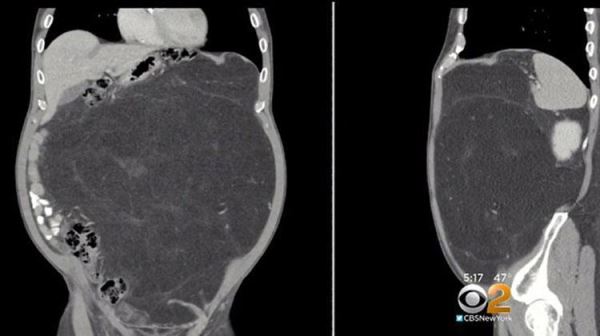 Пивной живот мужчины оказался 12-килограммовой опухолью, которую тот "выращивал" 10 лет